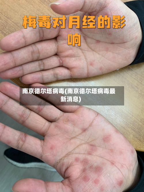 南京德尔塔病毒(南京德尔塔病毒最新消息)